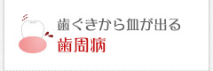 歯ぐきから血が出る 歯周病
